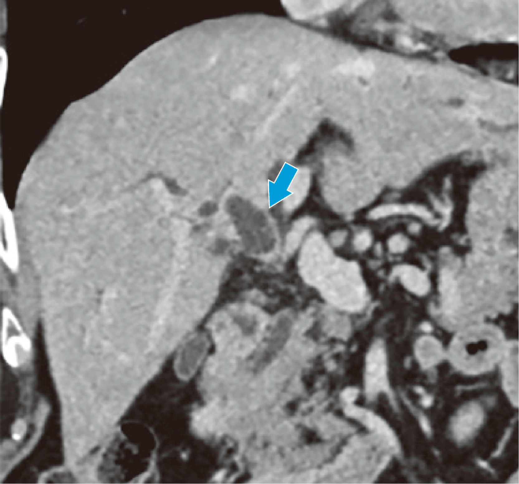 Fig. 4. Coronal section in the equilibrium phase (extent of progression in the right hepatic duct)