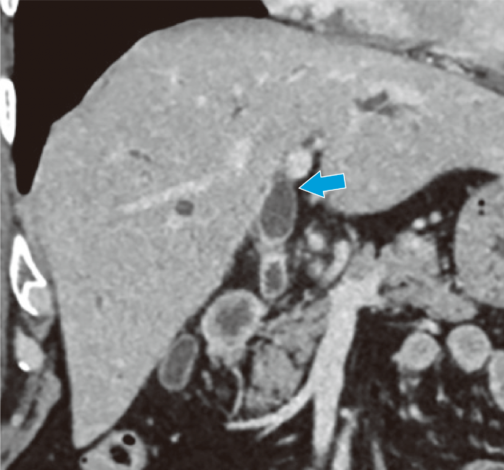 Fig. 5. Coronal section in the equilibrium phase (extent of progression in the left hepatic duct)