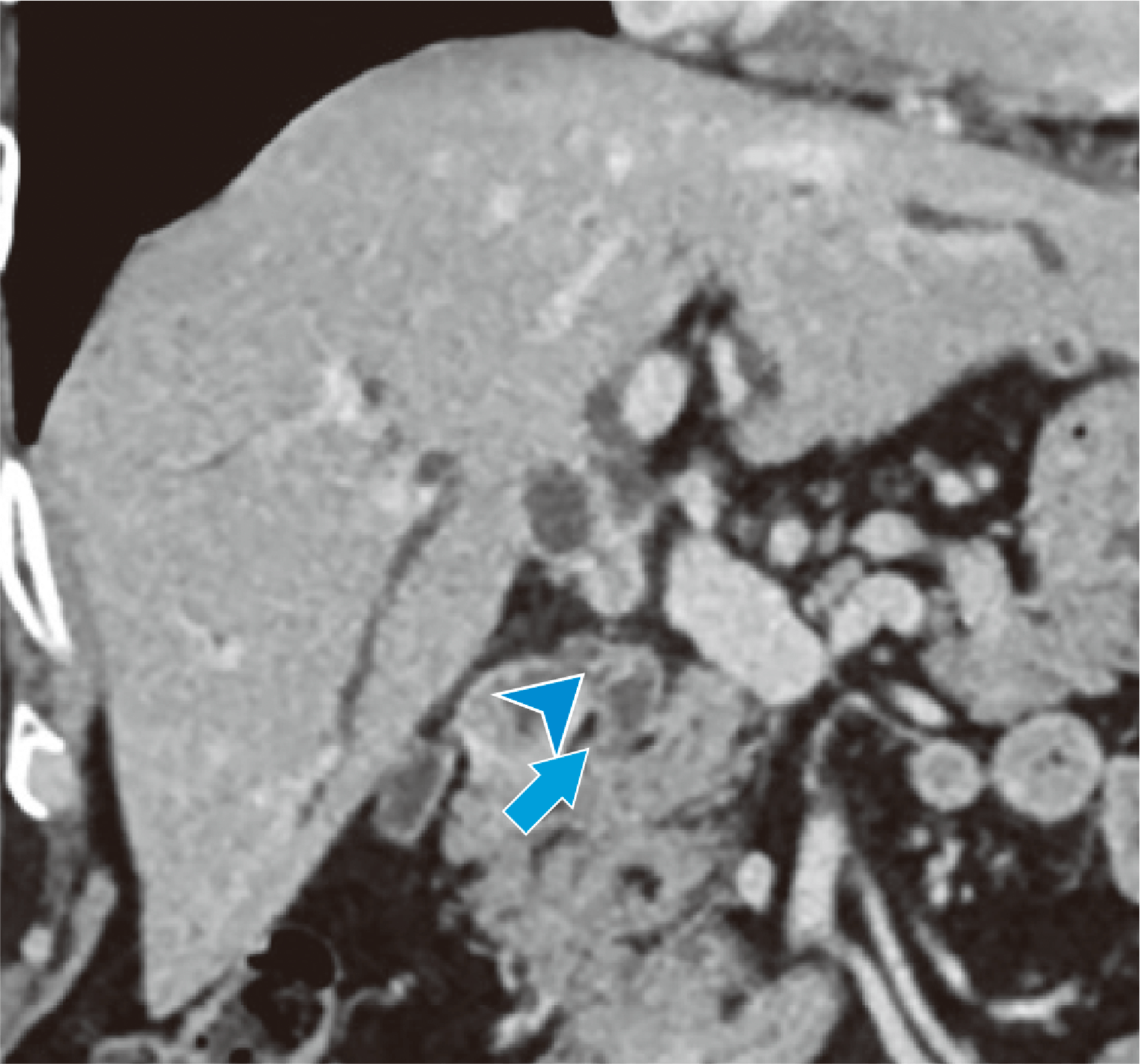 Fig. 6. Coronal section in the equilibrium phase (extent of progression on the duodenal side)
