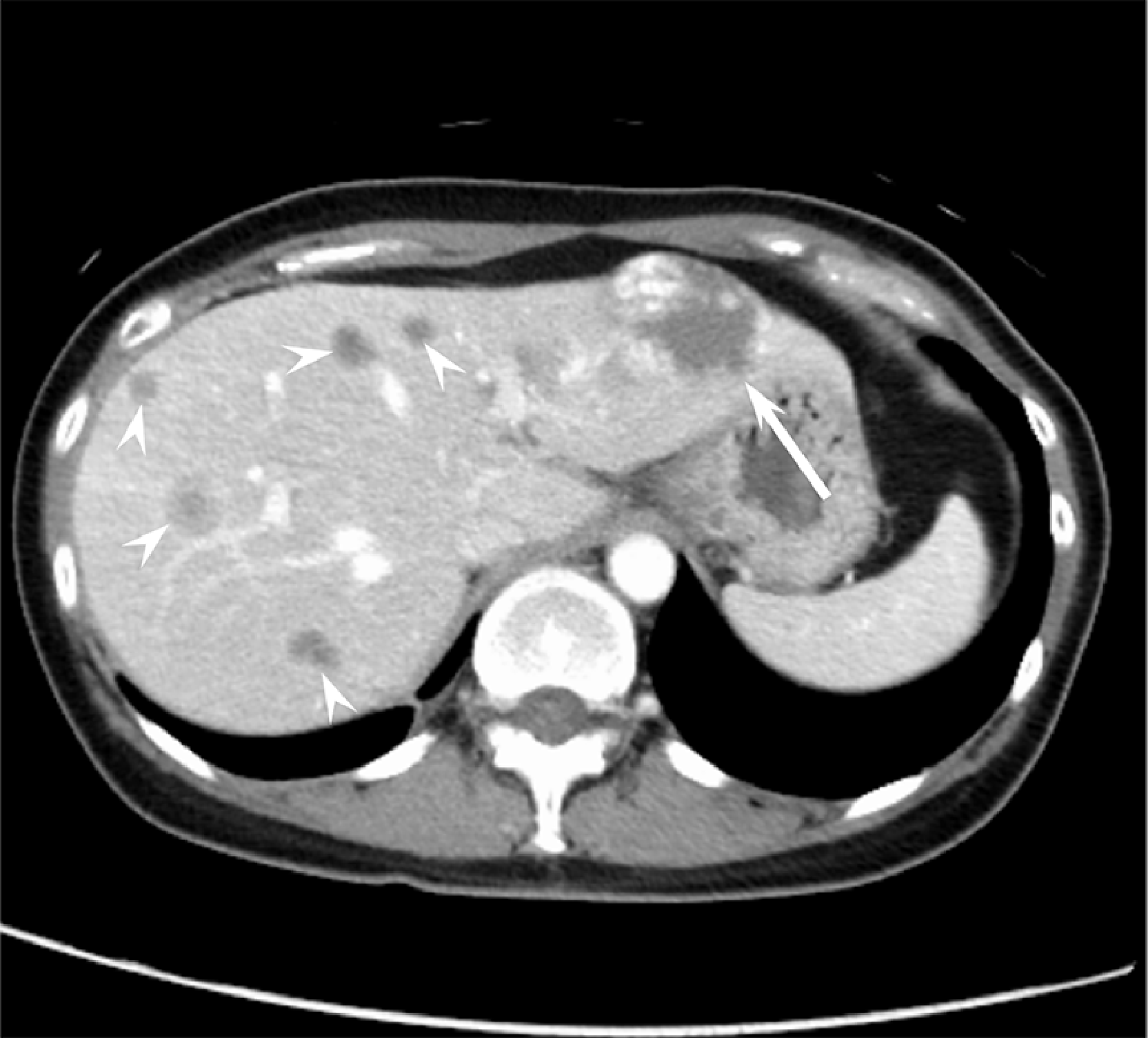Fig. 1. Axial section (umbilical level on portal vein)