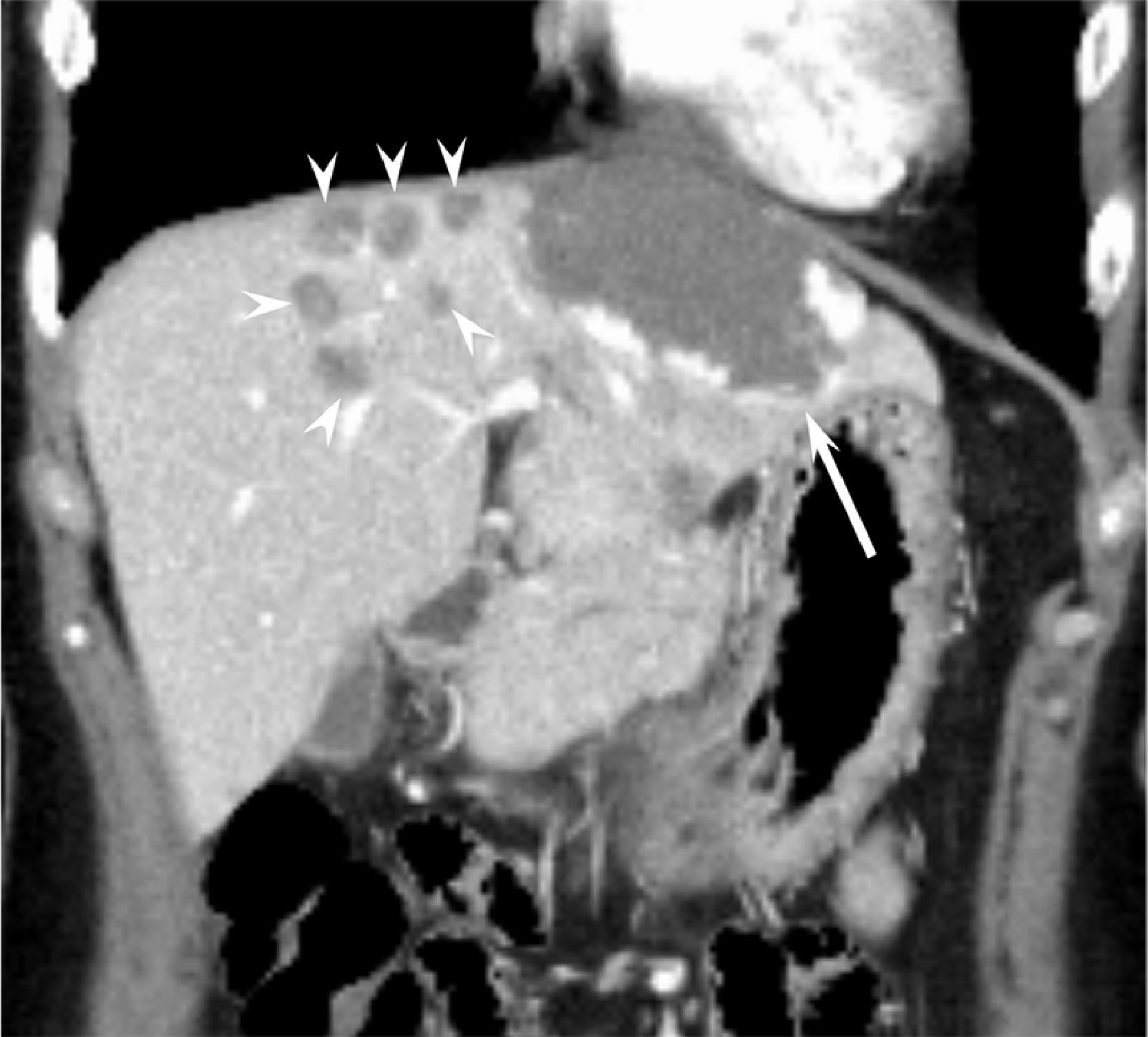 Fig. 2. Coronal section reconstruction (left branch level on portal vein)