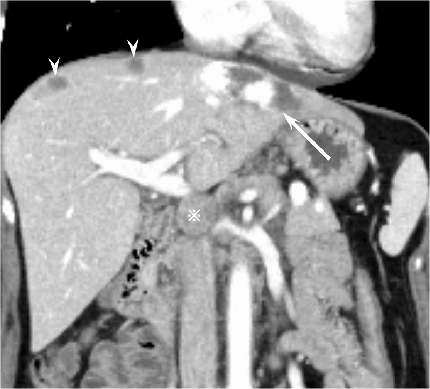 Fig. 3. Coronal section reconstruction (branch level on portal vein)