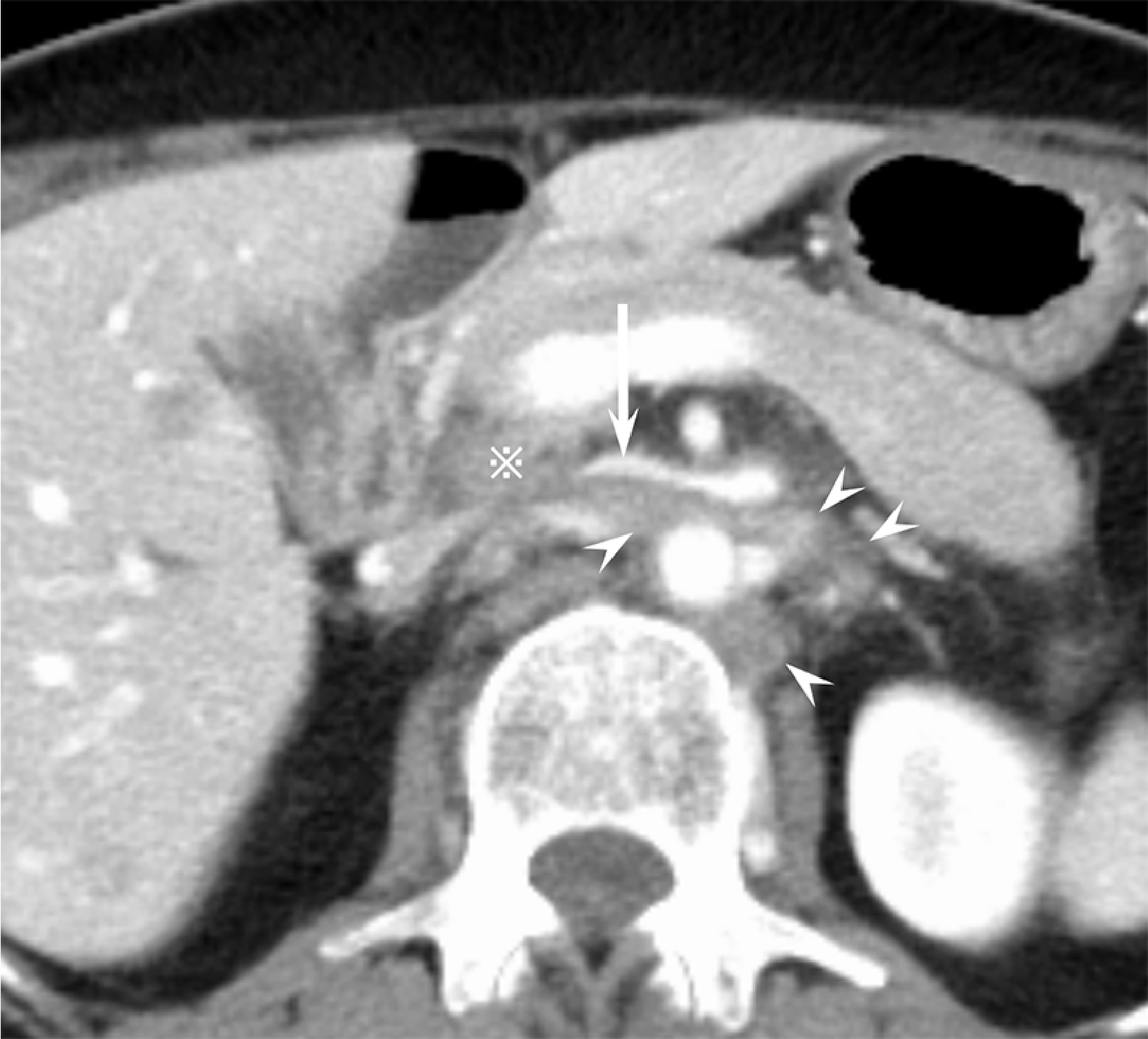 Fig. 4. Axial section (splenic vein level)