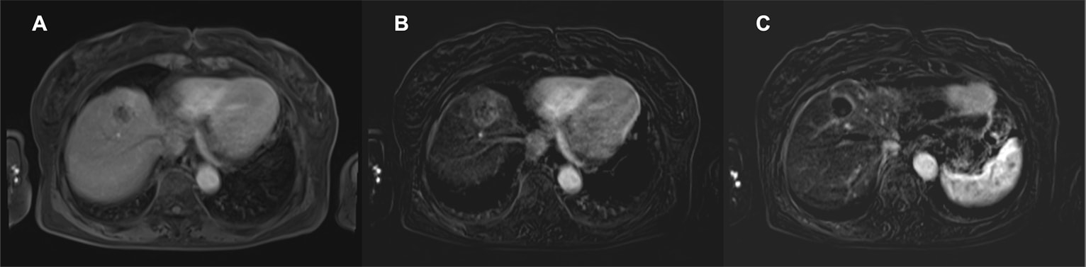 Fig. 2. EOB-MRI arterial phase