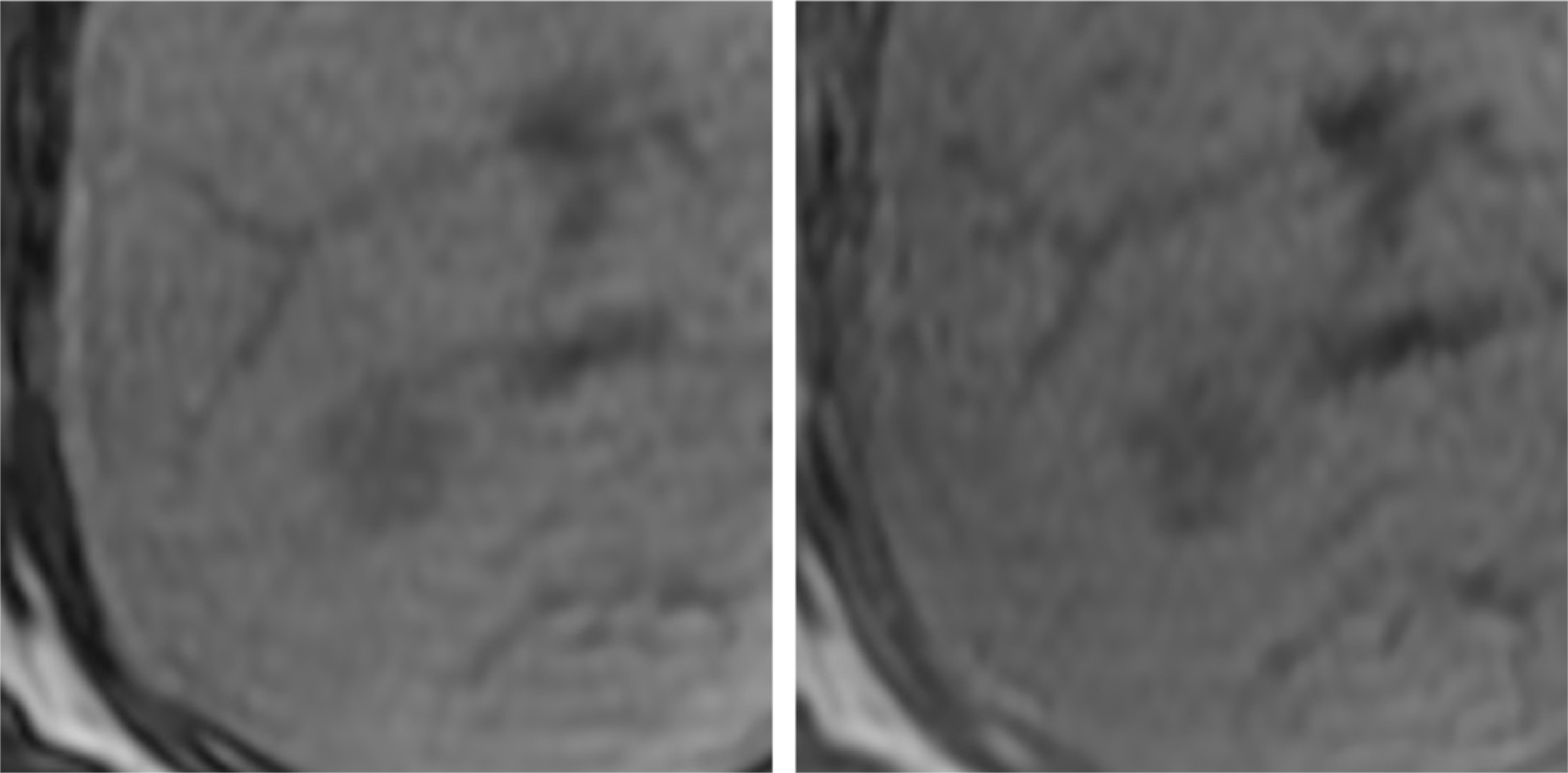 Fig. 2. T1-weighted imaging (in phase and opposed phase)