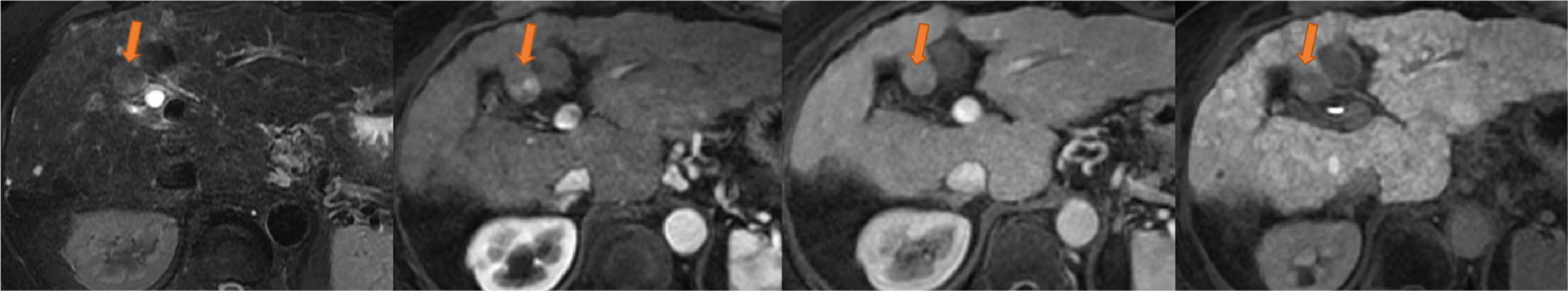 Fig. 3. EOB-MRI after 46 months (from left to right: fat-suppressed T2-weighted imaging; arterial phase; portal phase; hepatobiliary phase)