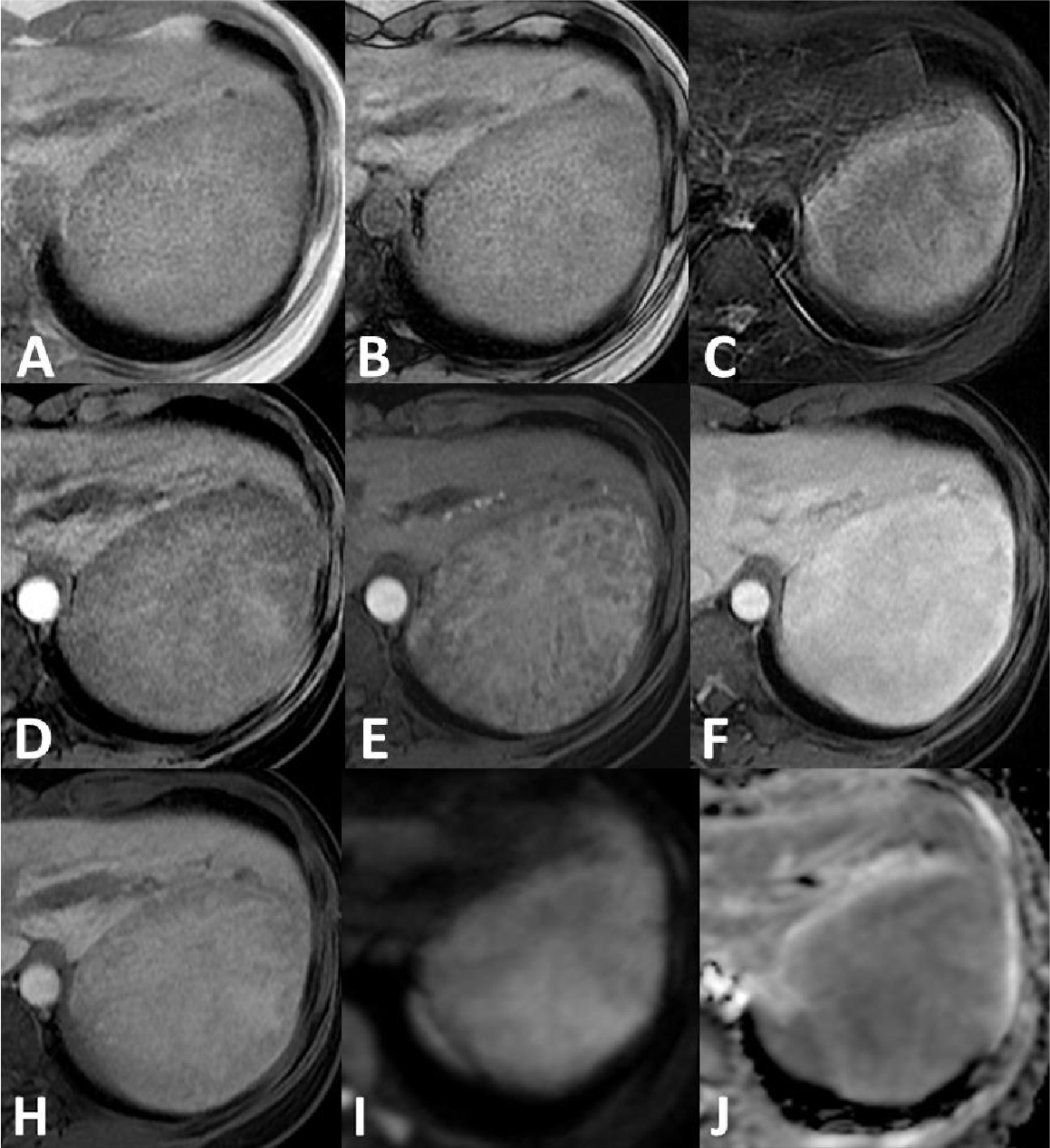 Fig. 2. Gd-EOB-DTPA enhanced MRI